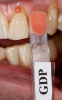 Fig 3. After using a very fine lead pencil to mark the curvilinear nature of the anatomical root area, a small spherical shaped amount of gingival colored composite material was placed on the tooth, light-cured, and used for shade determination with a custom shade tab.