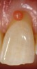 Fig 4. Close-up view showing the pink composite shade estimation on the gingival tissue.
