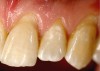 Fig 6. Preparation boundaries for teeth Nos. 9 and 11 that were completed using the pear-shaped diamond.