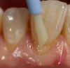 Fig 10. One layer of bonding agent was carefully applied to the preparations using a brush applicator, air-thinned, and then light-cured.