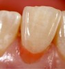 Fig 12. The layer of gingival-colored composite was placed at the base of the restoration to counteract the modulus of elasticity and establish the pink shade. It was sculpted to the margins and light-cured.
