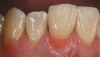 Fig 20. Postoperative view of the completed composite restorations provided to treat “the absence of pink.” Note that this gingival prosthetic solution is repairable, non-invasive, and cost-effective for patients.