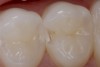 Fig 7. After slot preparation in the distal marginal ridge of tooth No. 5, proximal decalcification and decay at the dentino-enamel junction is clearly seen, although this lesion was not fully visible on radiographic examination.