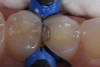 Fig 8. After isolation, a sectional matrix is placed to restore contact and proximal anatomic form to the composite to be placed. The goal is to perform as little rotary finishing and polishing as possible by having the matrix fit precisely to the cavity margins.