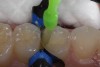 Fig 9. A self-etching bonding resin is scrubbed into the cavity preparation, air-thinned, and then light-cured according to manufacturer’s instructions.