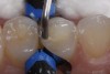 Fig 10. A Giomer bulk-fill flowable is used for this conservative slot preparation so that the entire cavity can be filled with one increment even though the depth of the proximal box is approximately 4 mm.