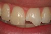 Fig 12. A Class IV mesial incisal fracture is shown from the facial aspect on tooth No. 9.