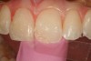 Fig 15. The initial increment of composite to replace the dentin is placed from the palatal aspect with the aid of a biaxially oriented polyethylene terephthalate (BoPET) strip.
