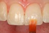 Fig 18. The clear enamel layer is smoothed with a sable artists’ brush before light-curing.