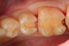 Fig 20. A distal-occlusal cavity preparation in tooth No. 29 and a mesial-occlusal-distal cavity preparation in tooth No. 30 are both shown from the occlusal aspect. A diode laser has been used interproximally to create supragingival margins to aid in precise gingival placement of the restorative material.