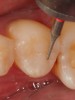 Fig 23. A needle-shaped diamond composite finishing instrument is used to refine the anatomic details before polishing the restoration.