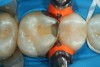 Fig 26. A mesial-occlusal cavity preparation on tooth No. 3 is shown after isolation and placement of a sectional matrix.