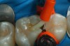 Fig 27. A self-etching adhesive resin is placed into the cavity preparation and then air-thinned and light-cured before placement of a low-shrink Giomer composite material.