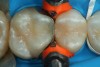 Fig 28. The low-shrink Giomer composite material is shown after placement in the mesial-occlusal cavity preparation in tooth No. 3 before light-curing.