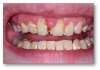 Fig 1. A patient was in need of soft-tissue recontouring and better esthetics.