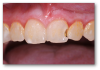 Fig 4. Emergency: broken tooth.