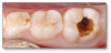 Fig 7. Deep decay in a child’s molar.