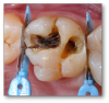 Fig 9. The clinician should drill until there is no leakage around the crack.