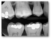 Fig 10. Radiopaque materials can be seen on a radiograph.