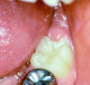 Fig 3. Erupting molars.