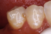 Fig 8. Preparation of Class III cavity.