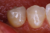 Fig 9. Class III giomer restoration.