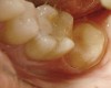 Fig 1. Tooth No. 18 crown build-up was directly restored.