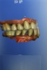 Fig 3. Digital bite restorations are best scanned before anesthesia and restorative care.