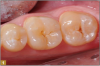 Fig 1. Subtle decay, occlusal view.