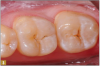 Fig 3. On the second molar, a #2 dental bur was used on a slow speed.