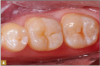 Fig 4. Caries indicator was used to ensure all decay was removed.