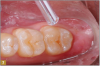 Fig 7. A bioactive flowable composite was self-leveled into grooves, covering the dentin with a thin layer about 2 mm deep.
