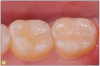 Fig 10. A patient with proximal decay on the incisors and some occlusal decay on molars had a layer of bioactive flowable composite placed over the dentin, which was then light-cured, and then the remainder of the restoration was built on the bioactive flowable.