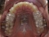 Fig 11. The appliance worn during treatment, anterior view (Fig 8), right side view (Fig 9), left side view (Fig 10), and upper arch view (Fig 11).
