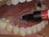 Fig 3. A heavy-bodied Giomer flowable composite is used to restore the preparation made in tooth No. 29.