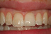 Fig 19. The completed Class IV Giomer restoration is seen on tooth No. 9 from the facial aspect. Note the esthetic quality of this layered anterior composite restoration as it compares with the surrounding natural teeth.