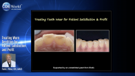 Treating Worn Dentition for Patient Satisfaction and Profit Webinar Thumbnail